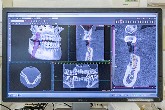 歯科用CT